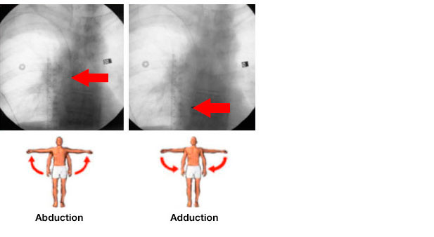 Catheter tip displacement after arm movement.