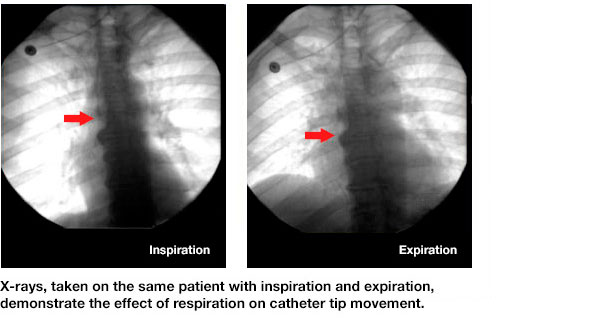 X-rays, taken on the same patient with inspiration and expiration, demonstrate the effect of respiration on catheter tip movement.