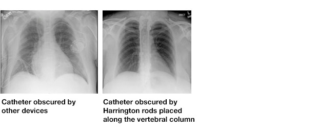 Catheter tip X-ray