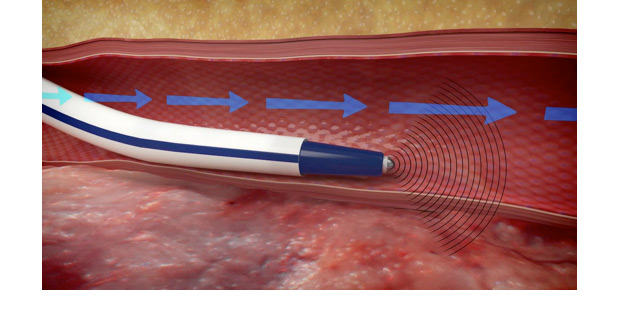 ARROW VPS G4 doppler microsensor